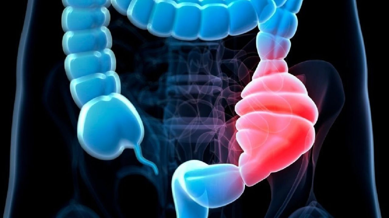 Yoğurt mucizesi: Bağırsak kanserine karşı koruyucu kalkan! İşte etkisi... - Sayfa 5