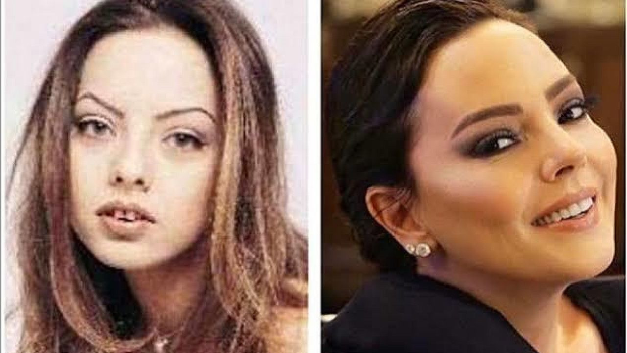 Ünlülerin yıllar içindeki değişimine inanamayacaksınız! Sanki yıllar geçmemiş gibi! İşte ünlülerin estetikli halleri... - Sayfa 6