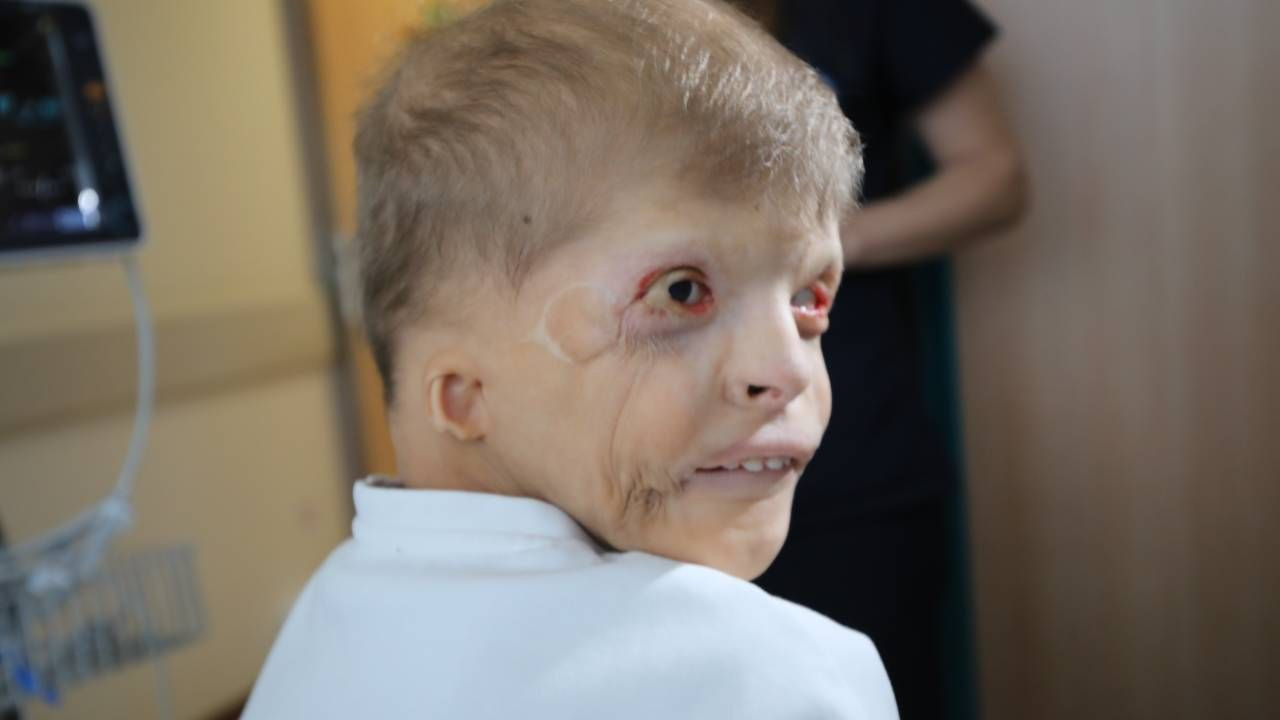 Savaş mağduru Ukraynalı çocuk milyonda 1 görülen hastalıkla doğdu, Türkiye'de şifa buldu - Sayfa 2