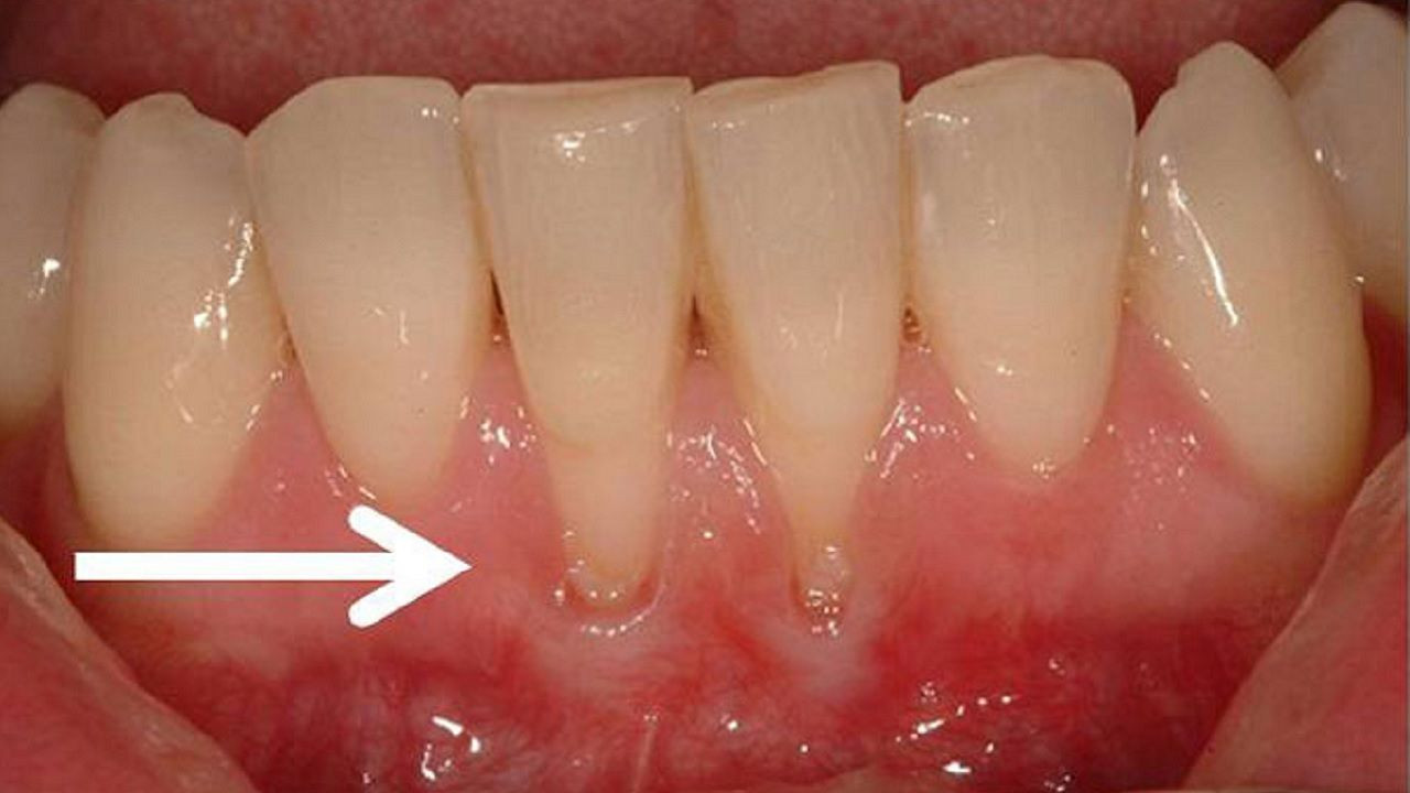 "Diş eti enfeksiyonu basit sanmayın, kalbinizin düşmanı olabilir!" Uzmanlardan kritik uyarı - Sayfa 5