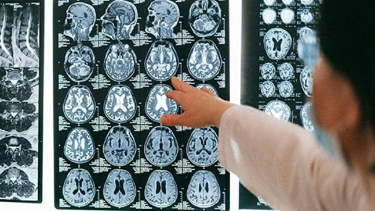 Şok eden araştırma: Beynimizde biriken mikroplastik miktarı 8 yılda yüzde 50 arttı! Sağlığımız ciddi tehdit altında! - Sayfa 1