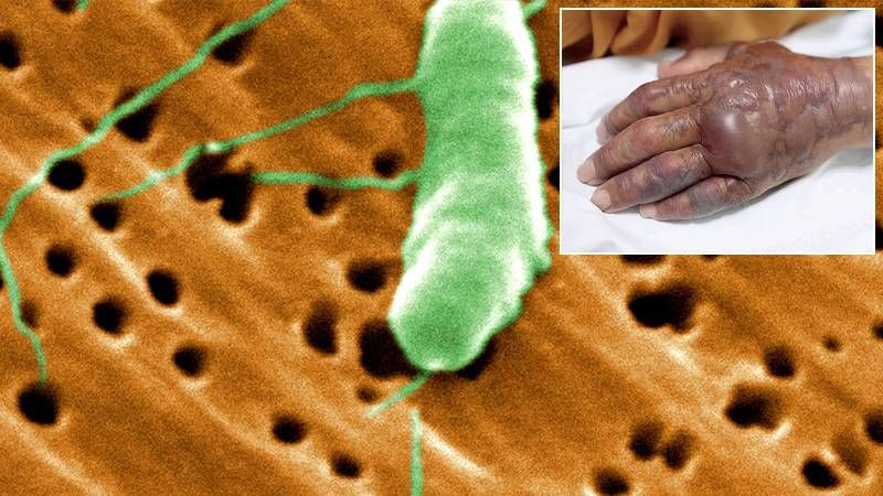 Et yiyen bakteri paniği! Sağlık Bakanlığı’ndan ‘Vibrio’ açıklaması: Türkiye’de vaka tespit edilmedi - Sayfa 6