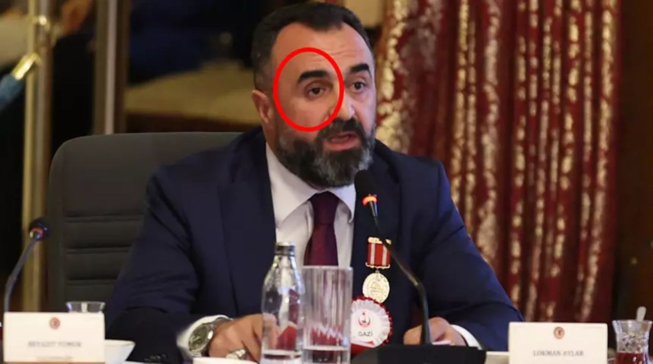 TBMM komisyonunda tarihi an! Lokman Aylar protez gözünü çıkarıp konuştu: Teröre bedel ödedim! - Sayfa 1