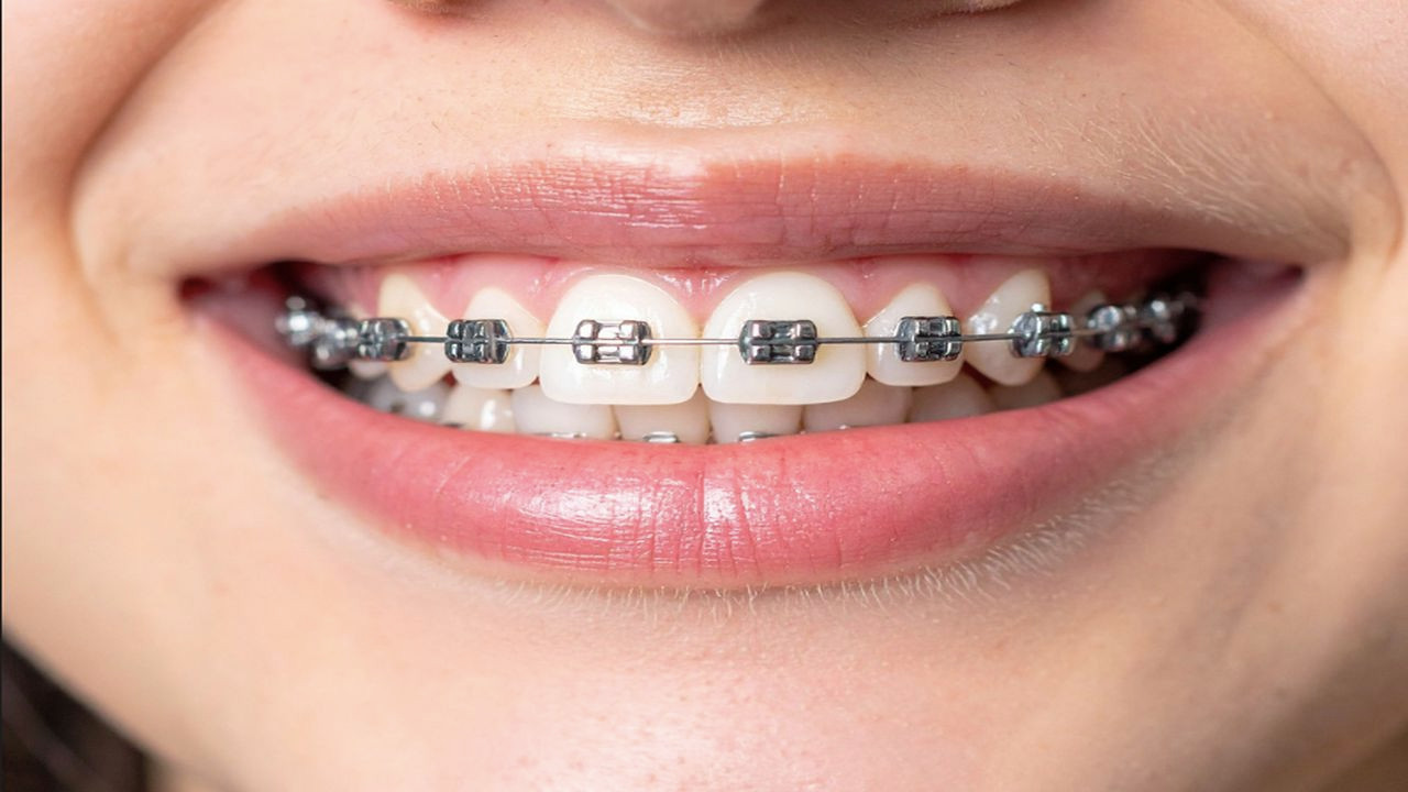 Diş Teli Tedavisinde Kişiye Özel Ortodontik Planlama