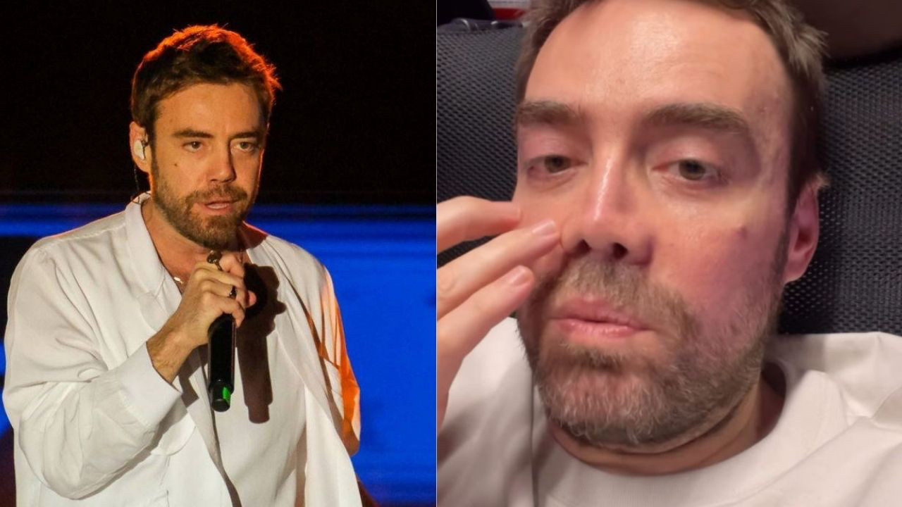 Murat Dalkılıç 13'üncü kez burun ameliyatı oldu! İşte son hali...