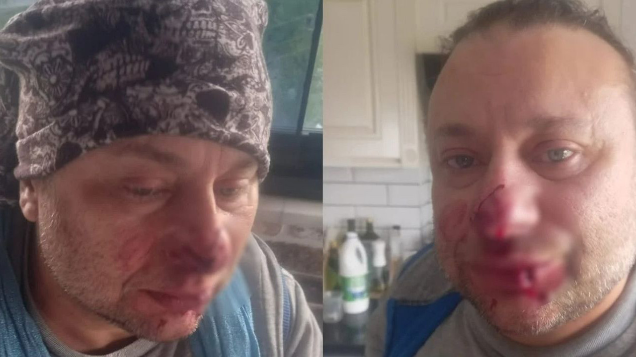 Başıboş pitbull saldırısı! Sanatçının burnunu ısırdı, et yiyen bakteri hastalığı ortaya çıktı: Entübe edildi...