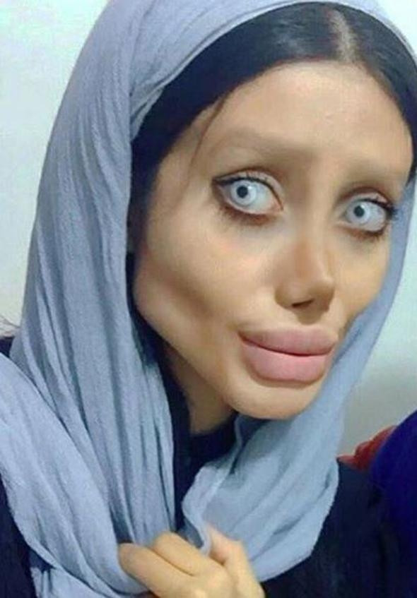 Angelina Jolie'ye benzemek için estetik oldu, insanlıktan çıktı! - Sayfa 9