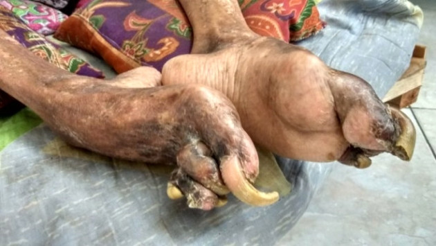 Geçirdiği kaza sonrası vücudu taşlaştı! - Sayfa 7